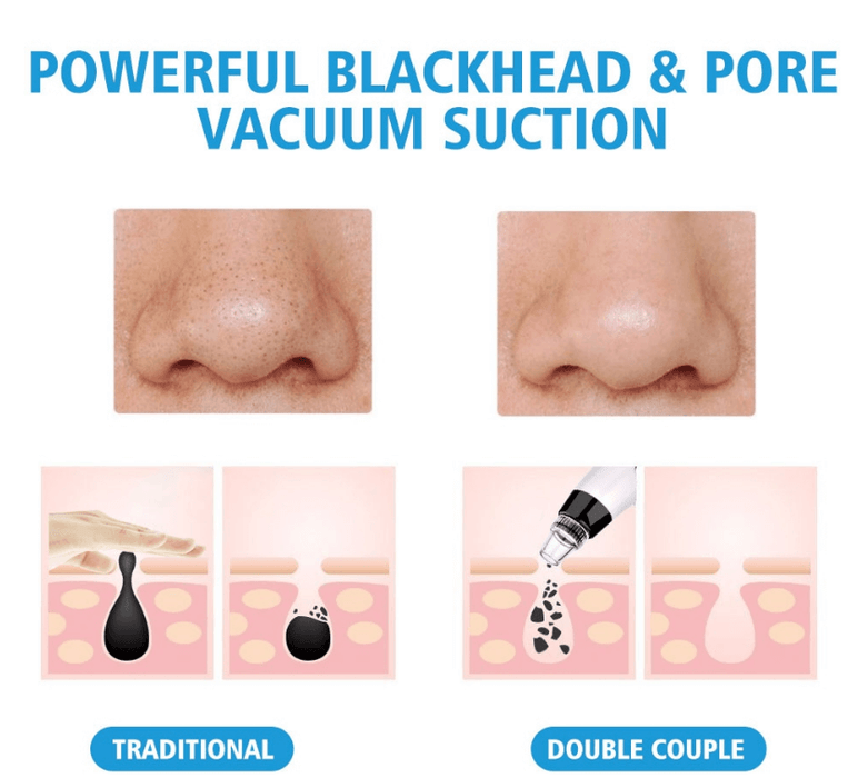 Skin Care Blackhead Acne Pore Remover Vacuum Resolve